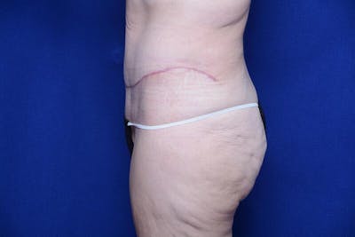 Abdominoplasty Before & After Gallery - Patient 197378 - Image 2