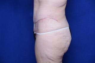 Abdominoplasty Before & After Gallery - Patient 197378 - Image 2