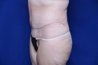 Abdominoplasty Before & After Gallery - Patient 197378 - Image 4
