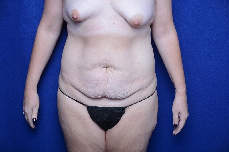 Abdominoplasty Before & After Gallery - Patient 197378 - Image 5