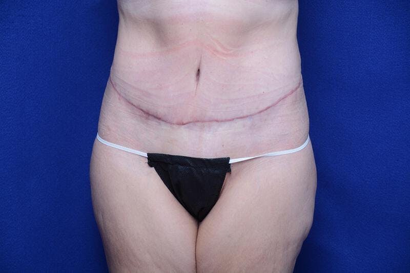 Abdominoplasty Before & After Gallery - Patient 197378 - Image 6