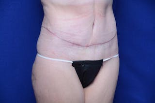 Abdominoplasty Before & After Gallery - Patient 197378 - Image 8