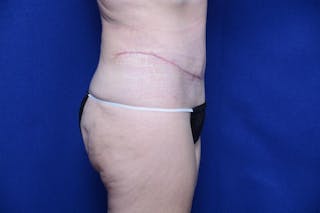 Abdominoplasty Before & After Gallery - Patient 197378 - Image 10