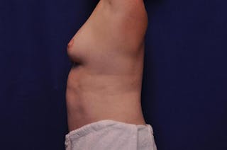 Abdominoplasty Before & After Gallery - Patient 325537 - Image 2