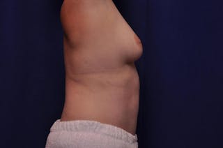 Abdominoplasty Before & After Gallery - Patient 325537 - Image 6