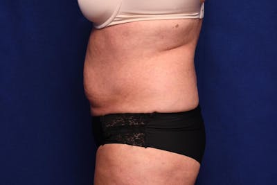 Abdominoplasty Before & After Gallery - Patient 203612 - Image 1