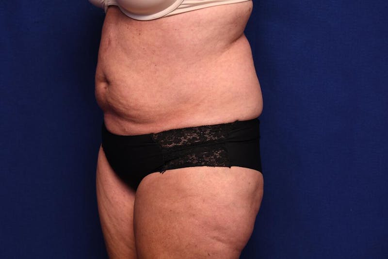 Abdominoplasty Before & After Gallery - Patient 203612 - Image 3