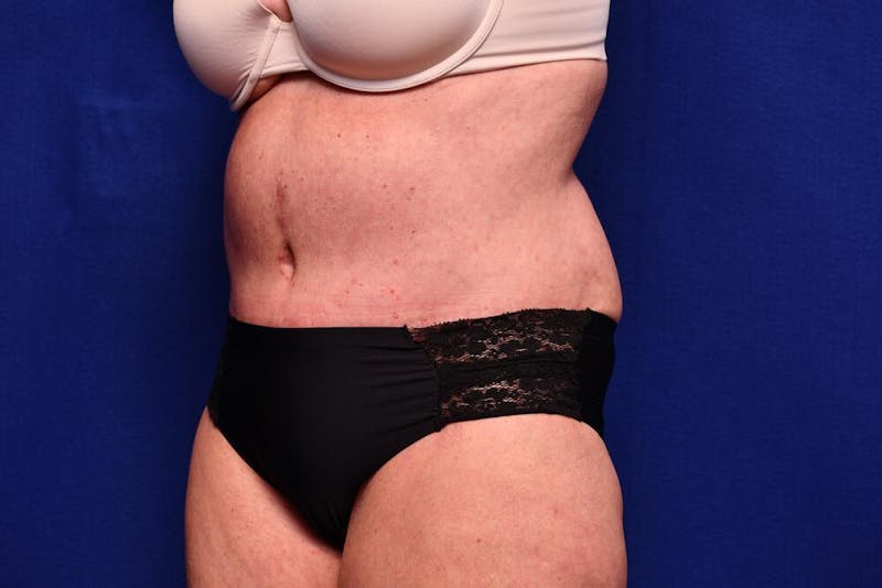 Abdominoplasty Before & After Gallery - Patient 203612 - Image 4