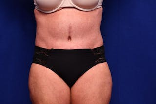 Abdominoplasty Before & After Gallery - Patient 203612 - Image 6