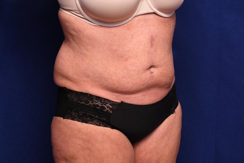 Abdominoplasty Before & After Gallery - Patient 203612 - Image 7