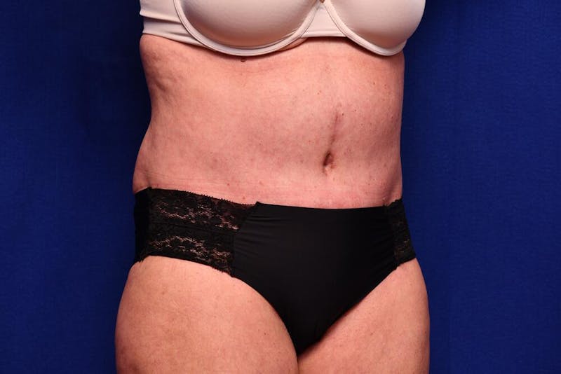 Abdominoplasty Before & After Gallery - Patient 203612 - Image 8