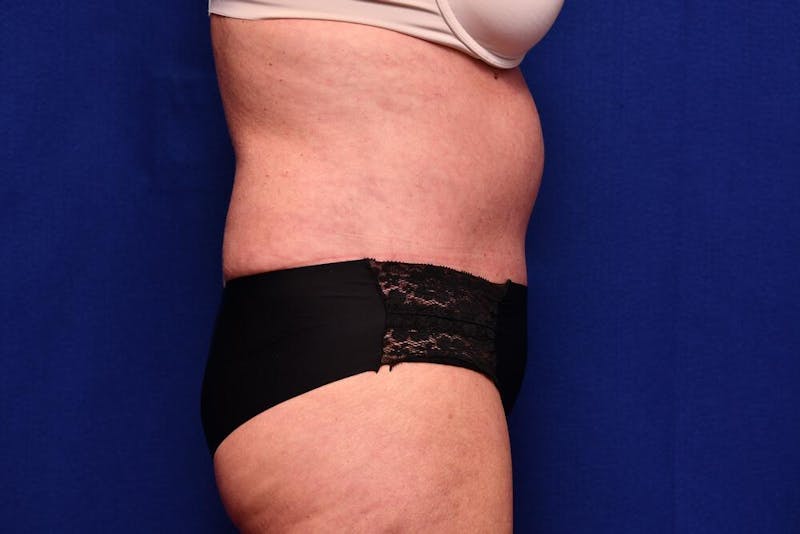 Abdominoplasty Before & After Gallery - Patient 203612 - Image 10