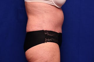 Abdominoplasty Before & After Gallery - Patient 203612 - Image 10