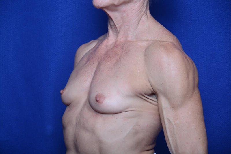 Athletic Breast Augmentation Before & After Gallery - Patient 417676 - Image 3