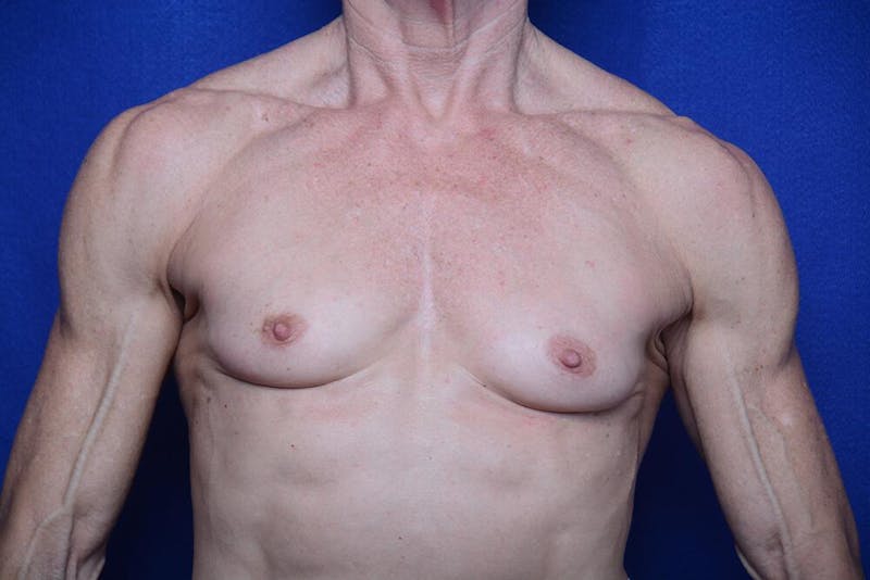 Athletic Breast Augmentation Before & After Gallery - Patient 417676 - Image 5