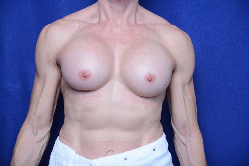 Athletic Breast Augmentation Before & After Gallery - Patient 417676 - Image 6