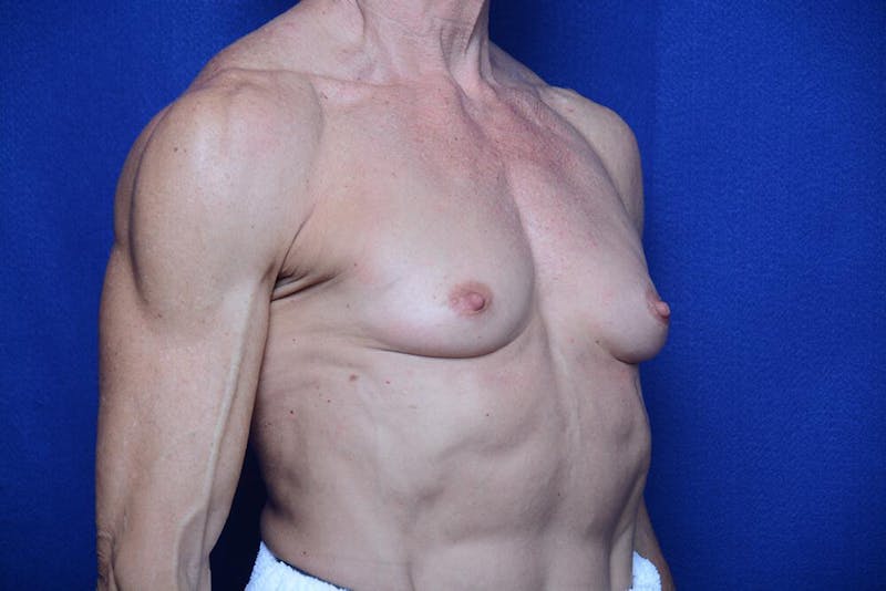 Athletic Breast Augmentation Before & After Gallery - Patient 417676 - Image 7