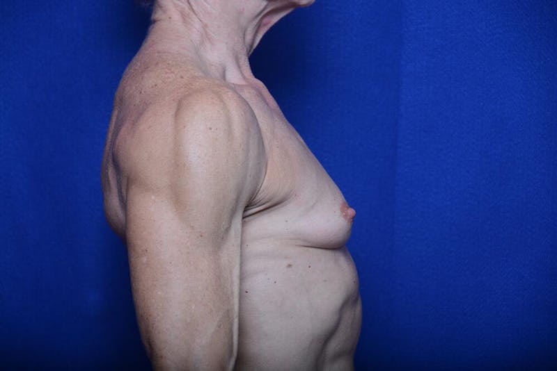 Athletic Breast Augmentation Before & After Gallery - Patient 417676 - Image 9