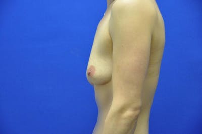 Athletic Breast Augmentation Before & After Gallery - Patient 248027 - Image 1