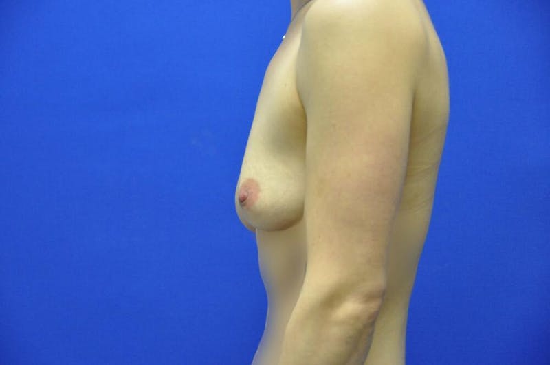 Athletic Breast Augmentation Before & After Gallery - Patient 248027 - Image 1