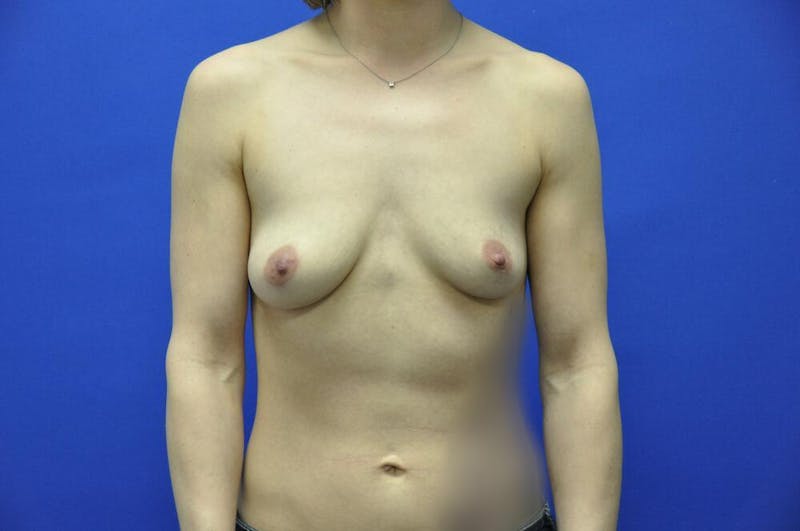 Athletic Breast Augmentation Before & After Gallery - Patient 248027 - Image 5