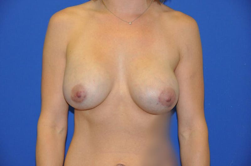 Athletic Breast Augmentation Before & After Gallery - Patient 248027 - Image 6