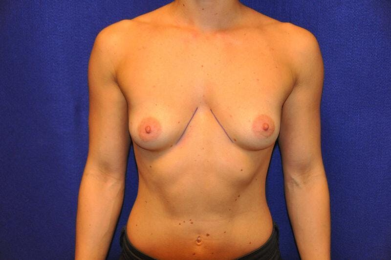 Athletic Breast Augmentation Before & After Gallery - Patient 143310 - Image 5