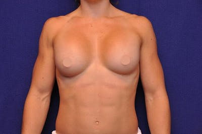 Athletic Breast Augmentation Before & After Gallery - Patient 368798 - Image 2