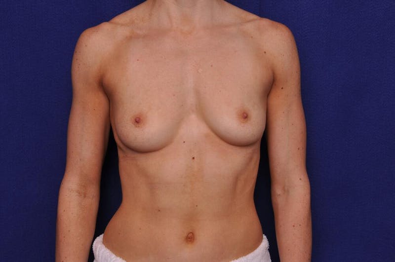 Athletic Breast Augmentation Before & After Gallery - Patient 596477 - Image 5