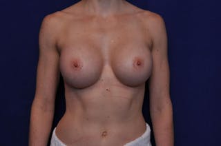 Athletic Breast Augmentation Before & After Gallery - Patient 596477 - Image 6