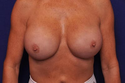 Athletic Breast Augmentation Revision Before & After Gallery - Patient 151085 - Image 2