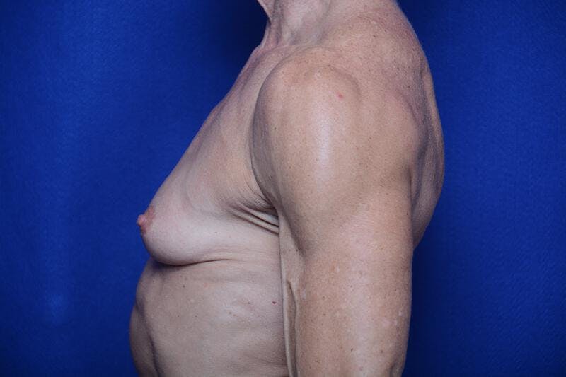 Athletic Breast Augmentation Revision Before & After Gallery - Patient 269817 - Image 3