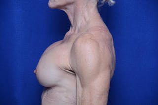 Athletic Breast Augmentation Revision Before & After Gallery - Patient 269817 - Image 4