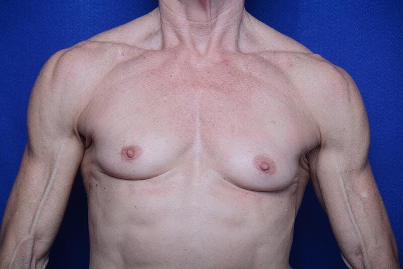 Athletic Breast Augmentation Revision Before & After Gallery - Patient 269817 - Image 1