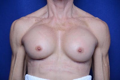 Athletic Breast Augmentation Revision Before & After Gallery - Patient 269817 - Image 2