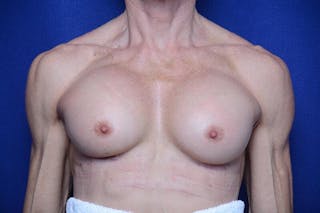 Athletic Breast Augmentation Revision Before & After Gallery - Patient 269817 - Image 2