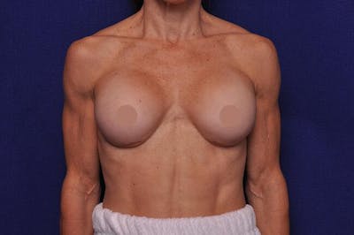 Athletic Breast Augmentation Revision Before & After Gallery - Patient 338121 - Image 1