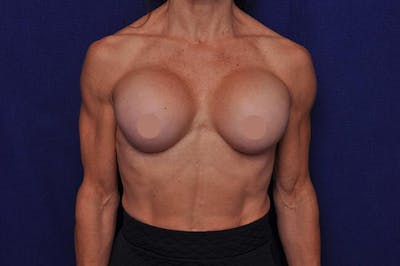 Athletic Breast Augmentation Revision Before & After Gallery - Patient 338121 - Image 2