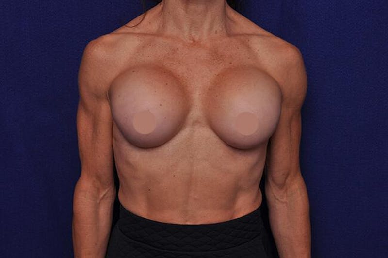 Athletic Breast Augmentation Revision Before & After Gallery - Patient 338121 - Image 2