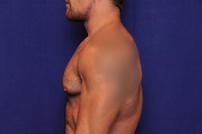 Bodybuilder Gynecomastia Before & After Gallery - Patient 224251 - Image 1