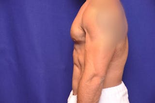 Bodybuilder Gynecomastia Before & After Gallery - Patient 224251 - Image 2