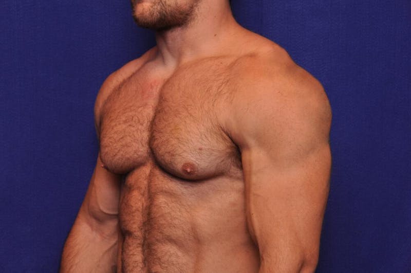 Bodybuilder Gynecomastia Before & After Gallery - Patient 224251 - Image 3