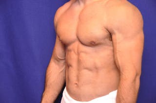 Bodybuilder Gynecomastia Before & After Gallery - Patient 224251 - Image 4