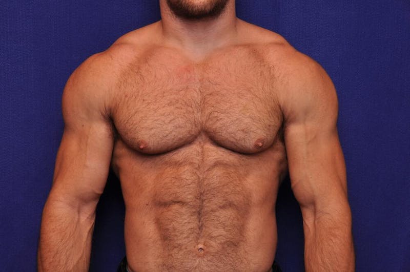 Bodybuilder Gynecomastia Before & After Gallery - Patient 224251 - Image 5