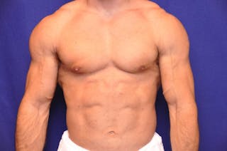 Bodybuilder Gynecomastia Before & After Gallery - Patient 224251 - Image 6