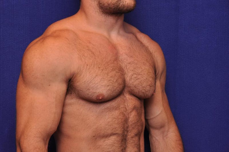 Bodybuilder Gynecomastia Before & After Gallery - Patient 224251 - Image 7