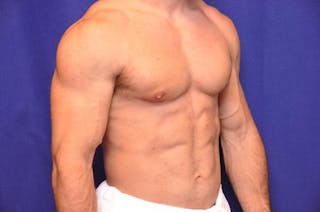 Bodybuilder Gynecomastia Before & After Gallery - Patient 224251 - Image 8