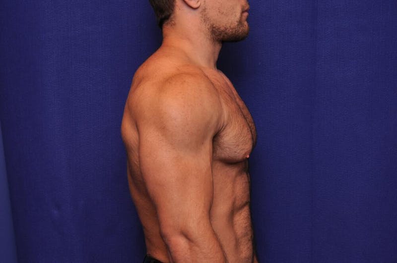 Bodybuilder Gynecomastia Before & After Gallery - Patient 224251 - Image 9