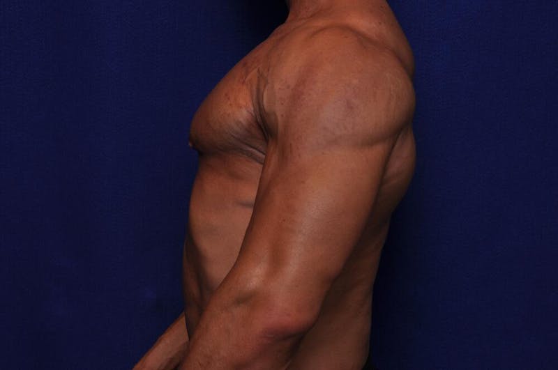 Bodybuilder Gynecomastia Before & After Gallery - Patient 291382 - Image 2