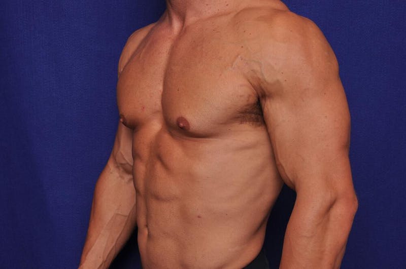 Bodybuilder Gynecomastia Before & After Gallery - Patient 291382 - Image 3